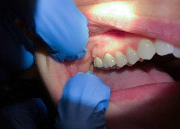 Best Emergency Treatment for Oral Infections in Amityville, NY